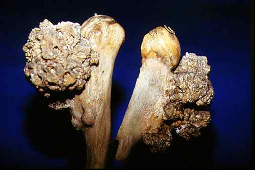 exostose